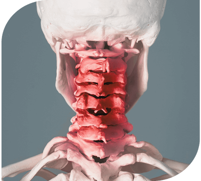 Cefalee cervicogena Patologii