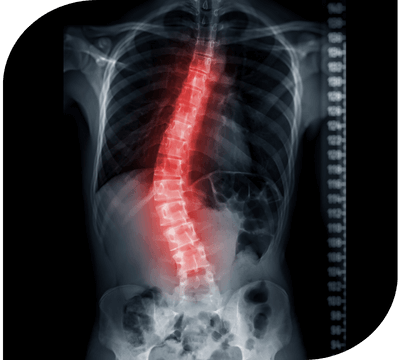 Scoliosis Patologii