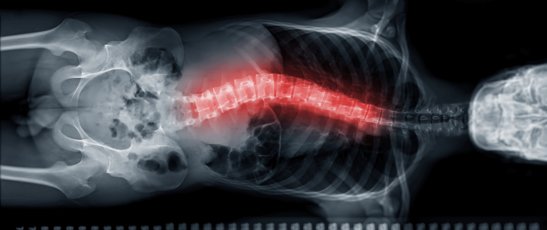 scoliosis